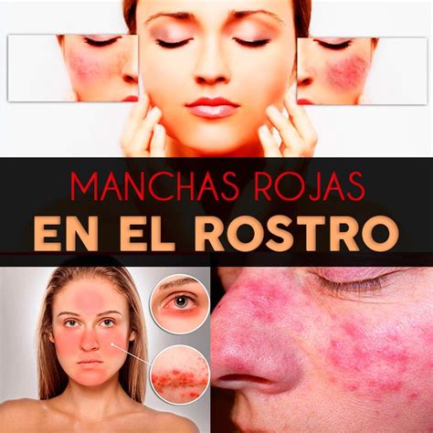 Manchas rojas en la piel: causas y remedios 